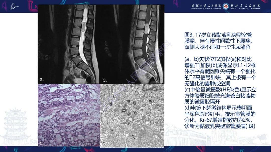 影像PPT - 【PPT】脊髓髓内占位影像诊断-16