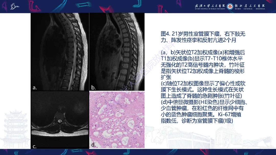 影像PPT - 【PPT】脊髓髓内占位影像诊断-19