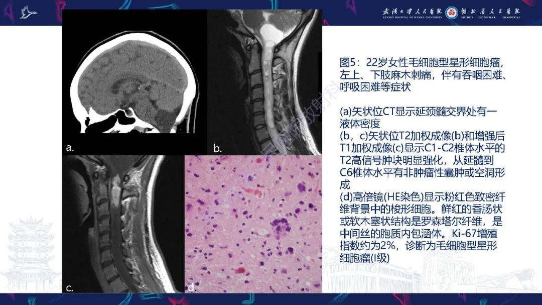 影像PPT - 【PPT】脊髓髓内占位影像诊断-23