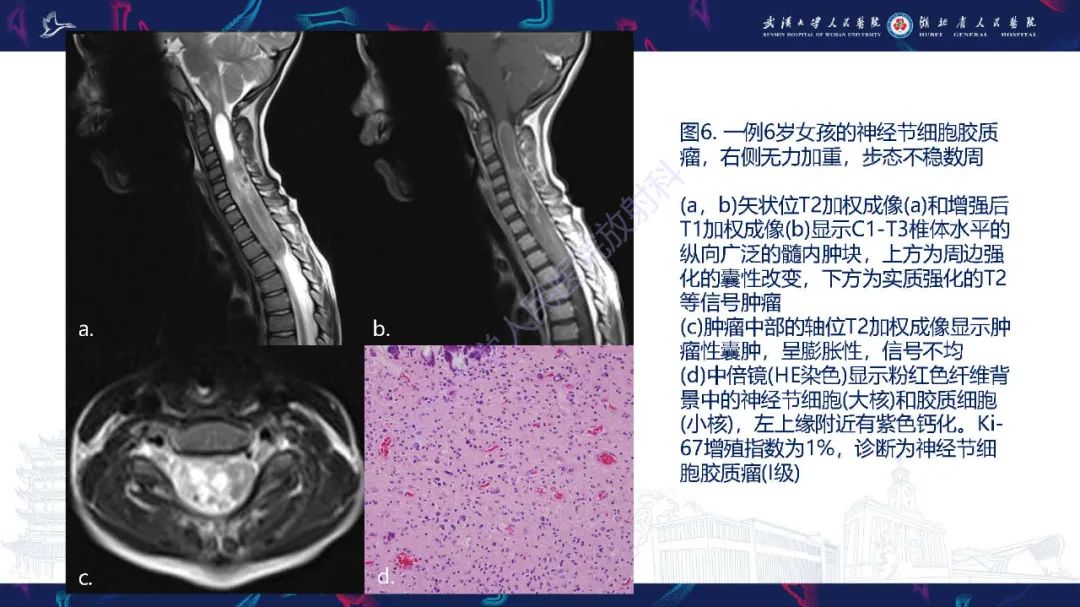 影像PPT - 【PPT】脊髓髓内占位影像诊断-25
