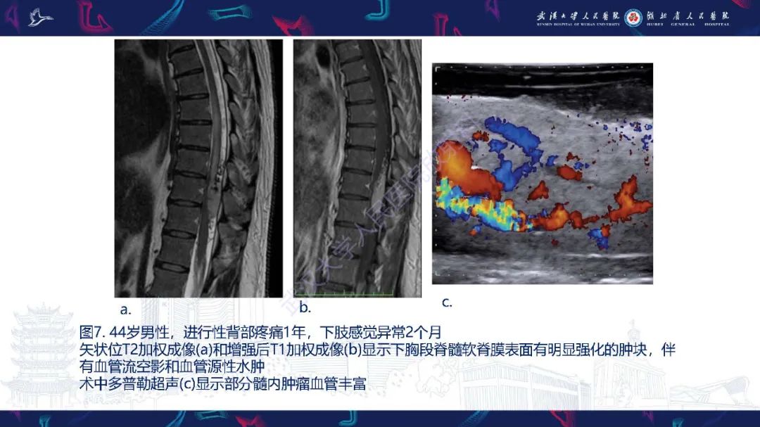 影像PPT - 【PPT】脊髓髓内占位影像诊断-28