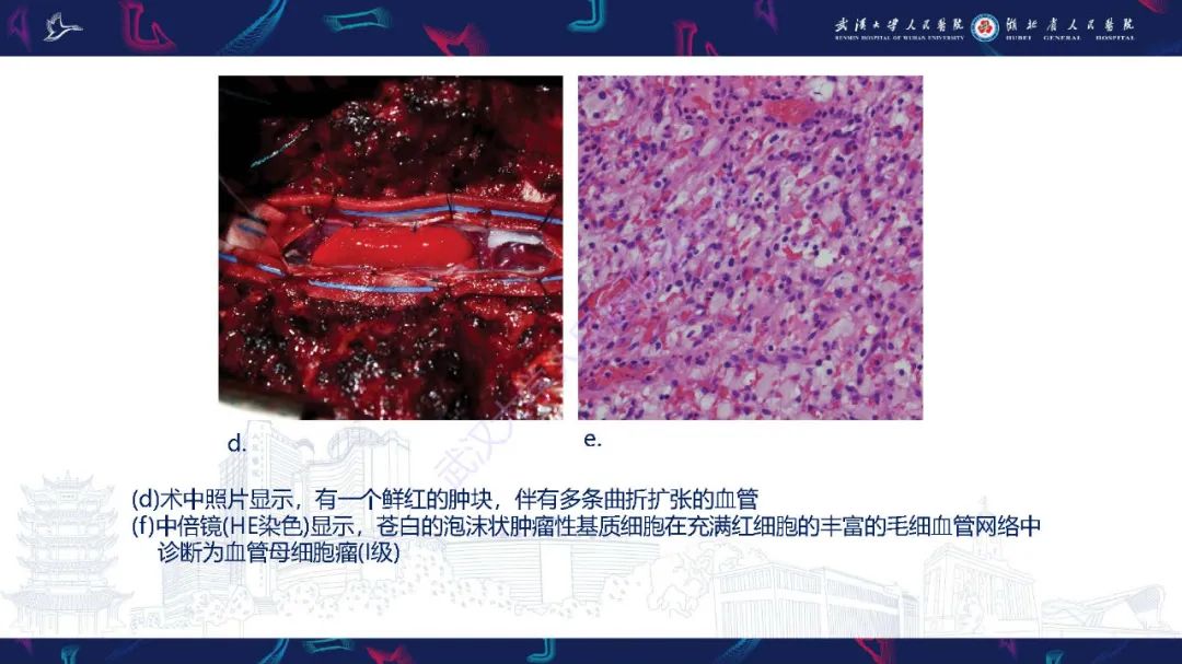 影像PPT - 【PPT】脊髓髓内占位影像诊断-29