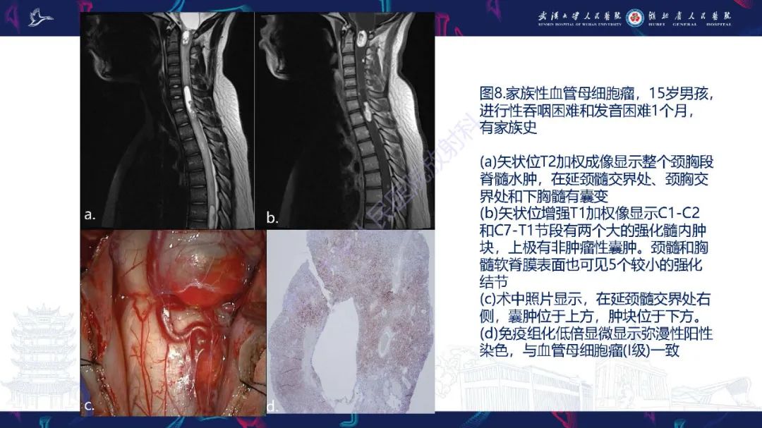 影像PPT - 【PPT】脊髓髓内占位影像诊断-30