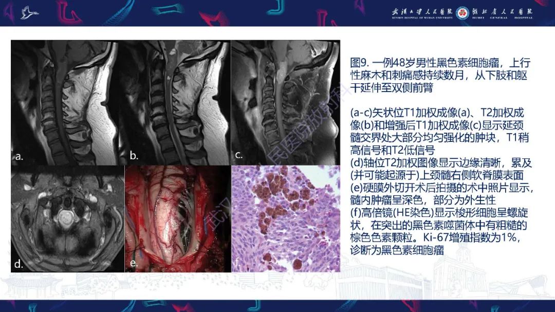影像PPT - 【PPT】脊髓髓内占位影像诊断-32