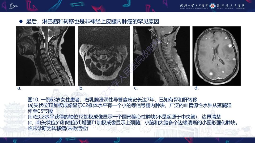 影像PPT - 【PPT】脊髓髓内占位影像诊断-33