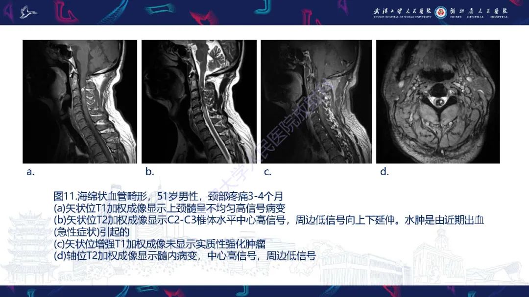影像PPT - 【PPT】脊髓髓内占位影像诊断-35