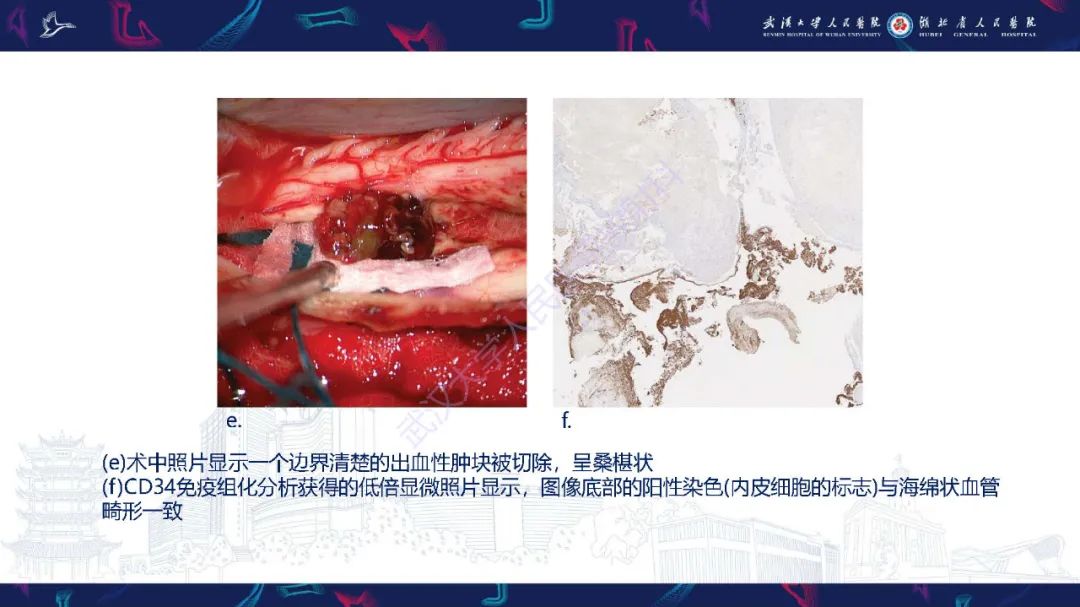 影像PPT - 【PPT】脊髓髓内占位影像诊断-36