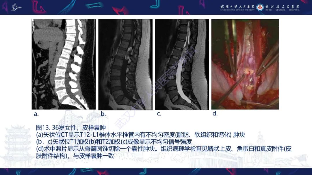 影像PPT - 【PPT】脊髓髓内占位影像诊断-38