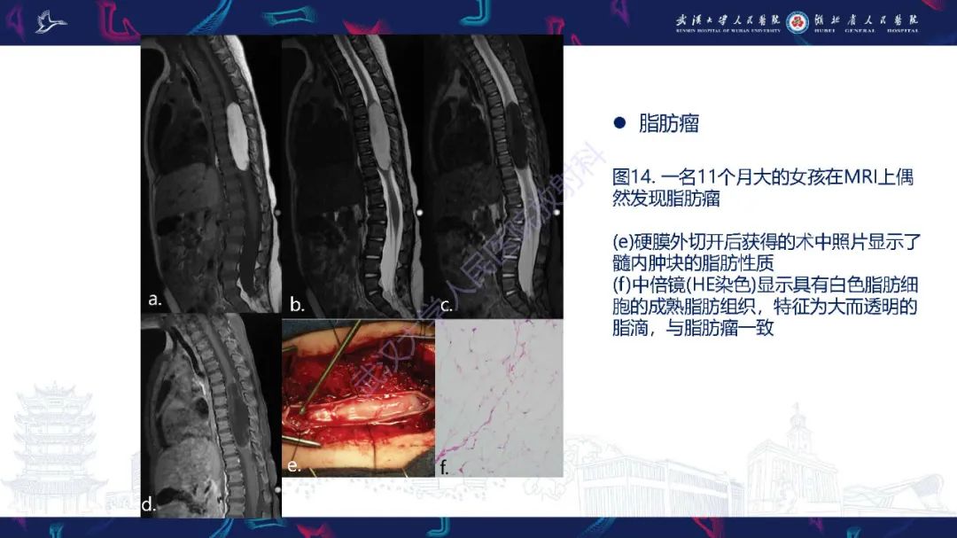 影像PPT - 【PPT】脊髓髓内占位影像诊断-39