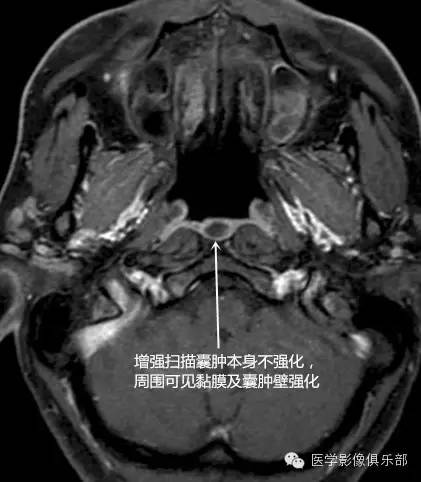 影像PPT - 咽囊囊肿-3 影像PPT - 咽囊囊肿-3