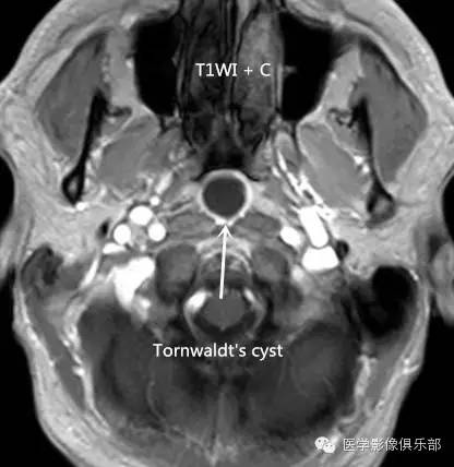 影像PPT - 咽囊囊肿-6 影像PPT - 咽囊囊肿-6