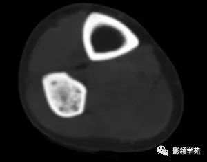 影像PPT - 【病例】慢性硬化性骨髓炎1例X线影像-2 影像PPT - 【病例】慢性硬化性骨髓炎1例X线影像-2