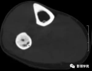 影像PPT - 【病例】慢性硬化性骨髓炎1例X线影像-3 影像PPT - 【病例】慢性硬化性骨髓炎1例X线影像-3