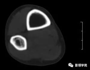 影像PPT - 【病例】慢性硬化性骨髓炎1例X线影像-4 影像PPT - 【病例】慢性硬化性骨髓炎1例X线影像-4