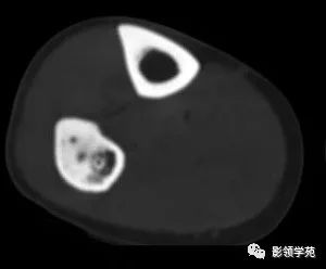 影像PPT - 【病例】慢性硬化性骨髓炎1例X线影像-5 影像PPT - 【病例】慢性硬化性骨髓炎1例X线影像-5