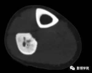 影像PPT - 【病例】慢性硬化性骨髓炎1例X线影像-6 影像PPT - 【病例】慢性硬化性骨髓炎1例X线影像-6