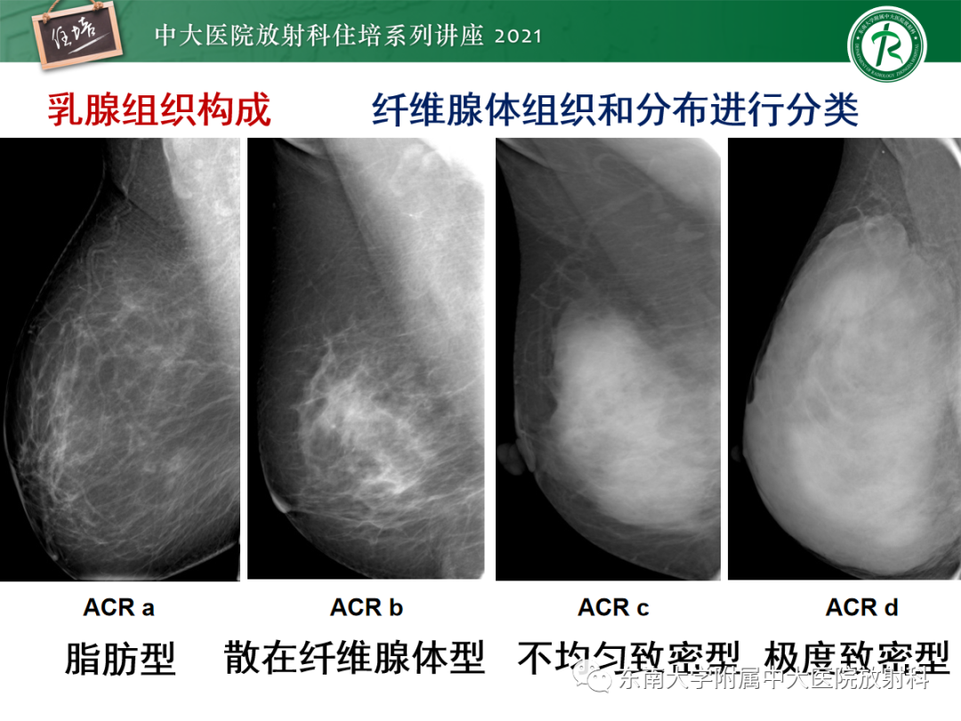影像PPT - 【PPT】乳腺X线影像报告和数据系统（第五版）BI-RADS-3