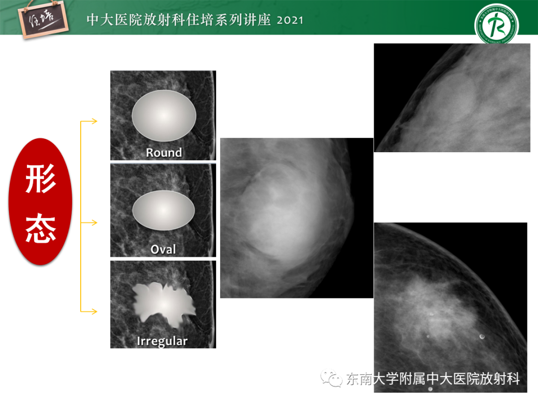 影像PPT - 【PPT】乳腺X线影像报告和数据系统（第五版）BI-RADS-8