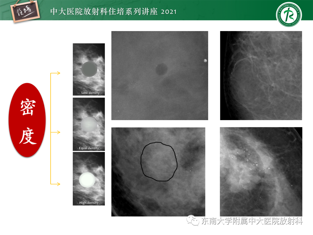 影像PPT - 【PPT】乳腺X线影像报告和数据系统（第五版）BI-RADS-9