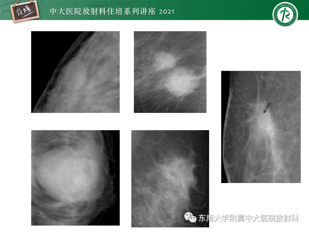 影像PPT - 【PPT】乳腺X线影像报告和数据系统（第五版）BI-RADS-12