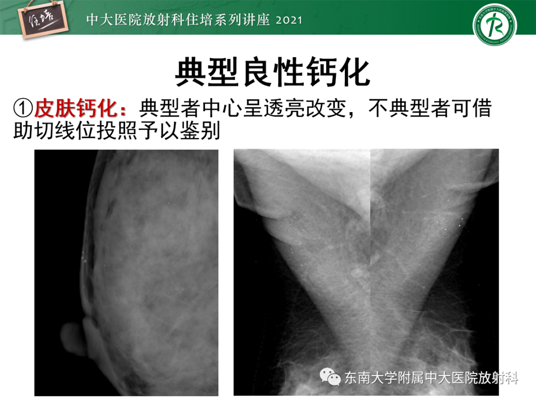 影像PPT - 【PPT】乳腺X线影像报告和数据系统（第五版）BI-RADS-19