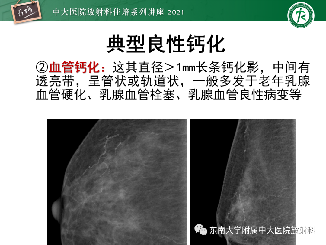影像PPT - 【PPT】乳腺X线影像报告和数据系统（第五版）BI-RADS-20
