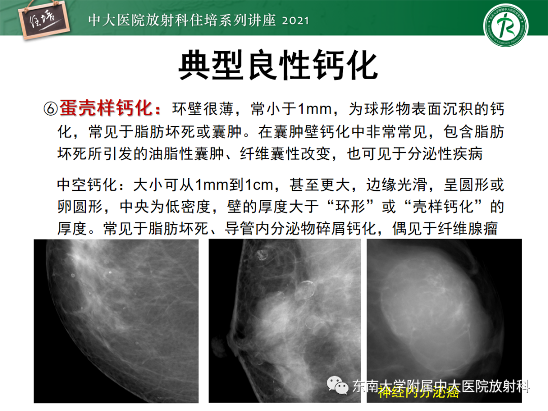 影像PPT - 【PPT】乳腺X线影像报告和数据系统（第五版）BI-RADS-24
