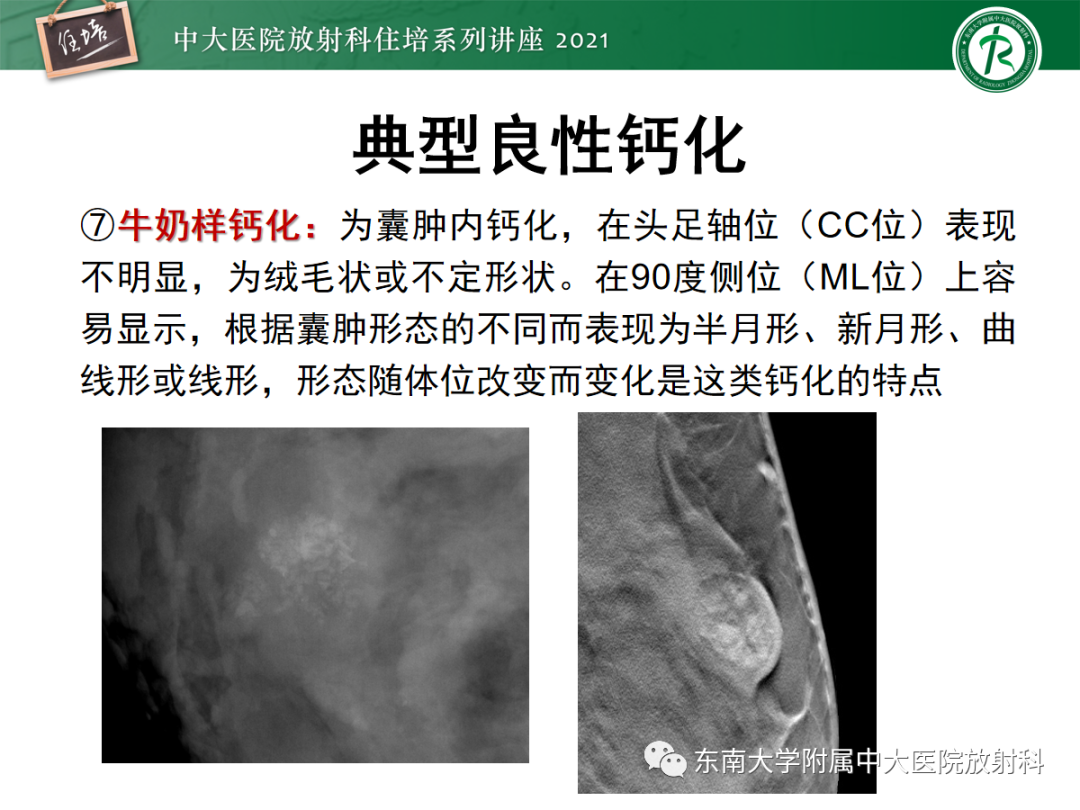 影像PPT - 【PPT】乳腺X线影像报告和数据系统（第五版）BI-RADS-25