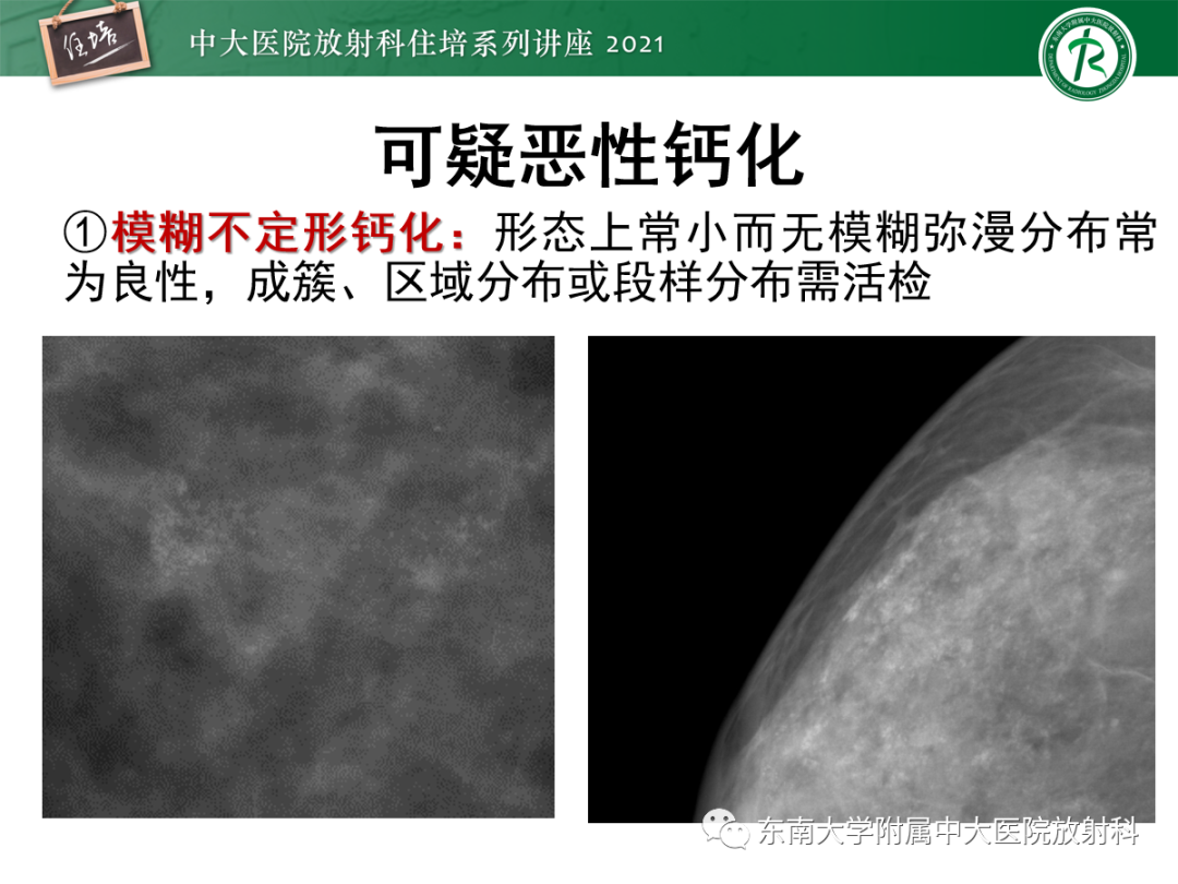 影像PPT - 【PPT】乳腺X线影像报告和数据系统（第五版）BI-RADS-29