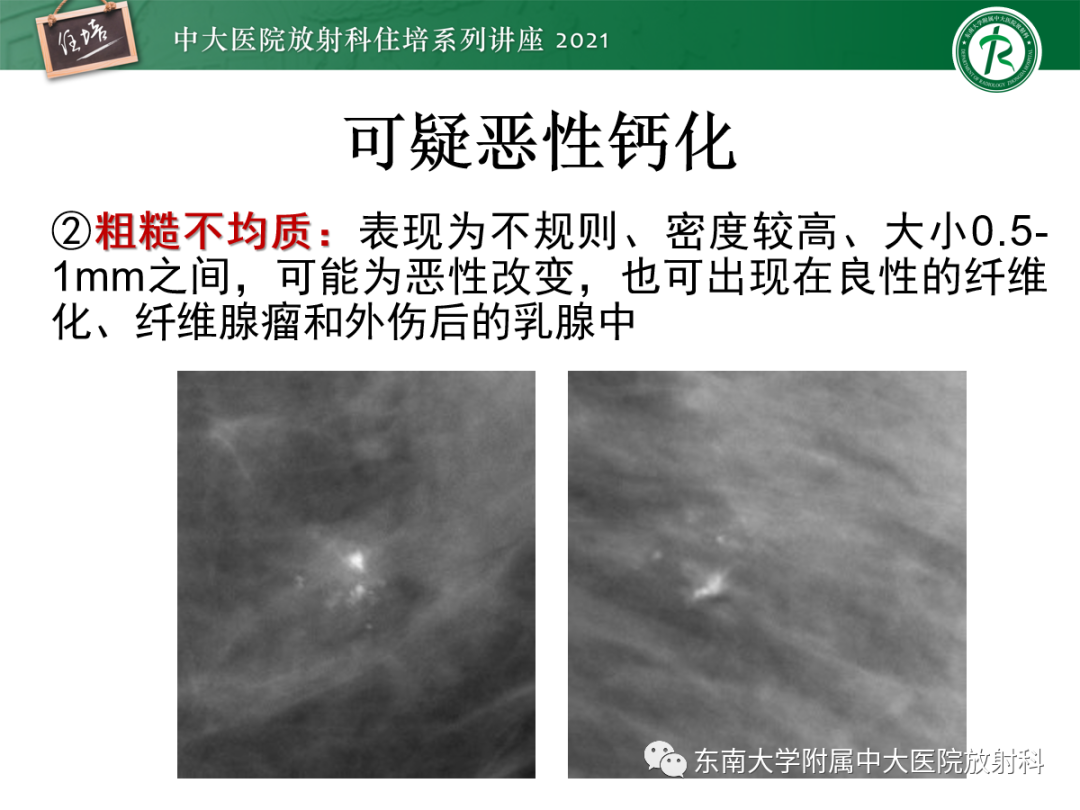 影像PPT - 【PPT】乳腺X线影像报告和数据系统（第五版）BI-RADS-30