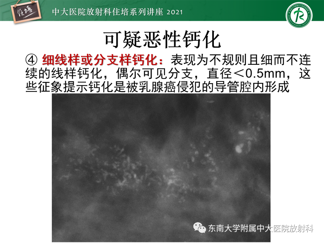 影像PPT - 【PPT】乳腺X线影像报告和数据系统（第五版）BI-RADS-32