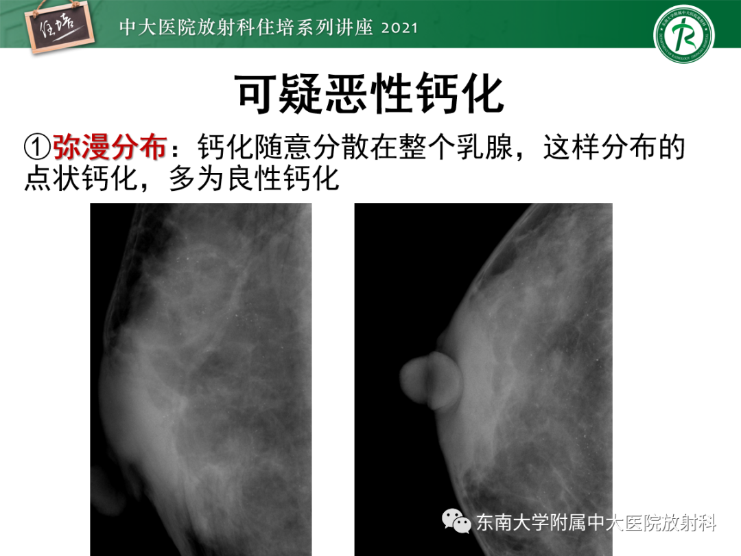 影像PPT - 【PPT】乳腺X线影像报告和数据系统（第五版）BI-RADS-34