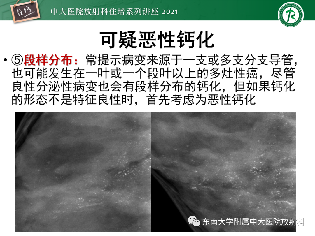 影像PPT - 【PPT】乳腺X线影像报告和数据系统（第五版）BI-RADS-38