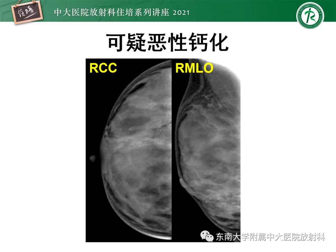 影像PPT - 【PPT】乳腺X线影像报告和数据系统（第五版）BI-RADS-39