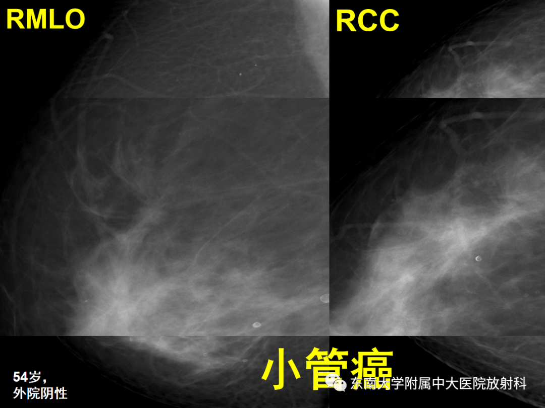 影像PPT - 【PPT】乳腺X线影像报告和数据系统（第五版）BI-RADS-43