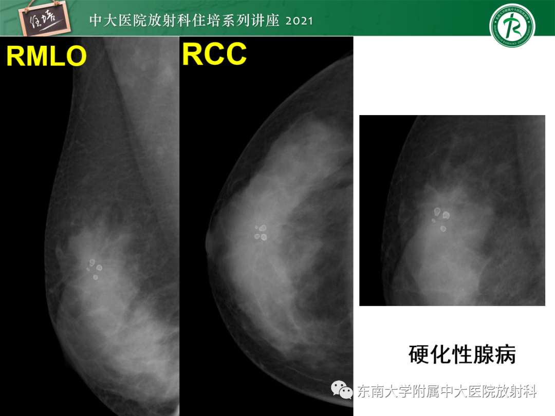 影像PPT - 【PPT】乳腺X线影像报告和数据系统（第五版）BI-RADS-44