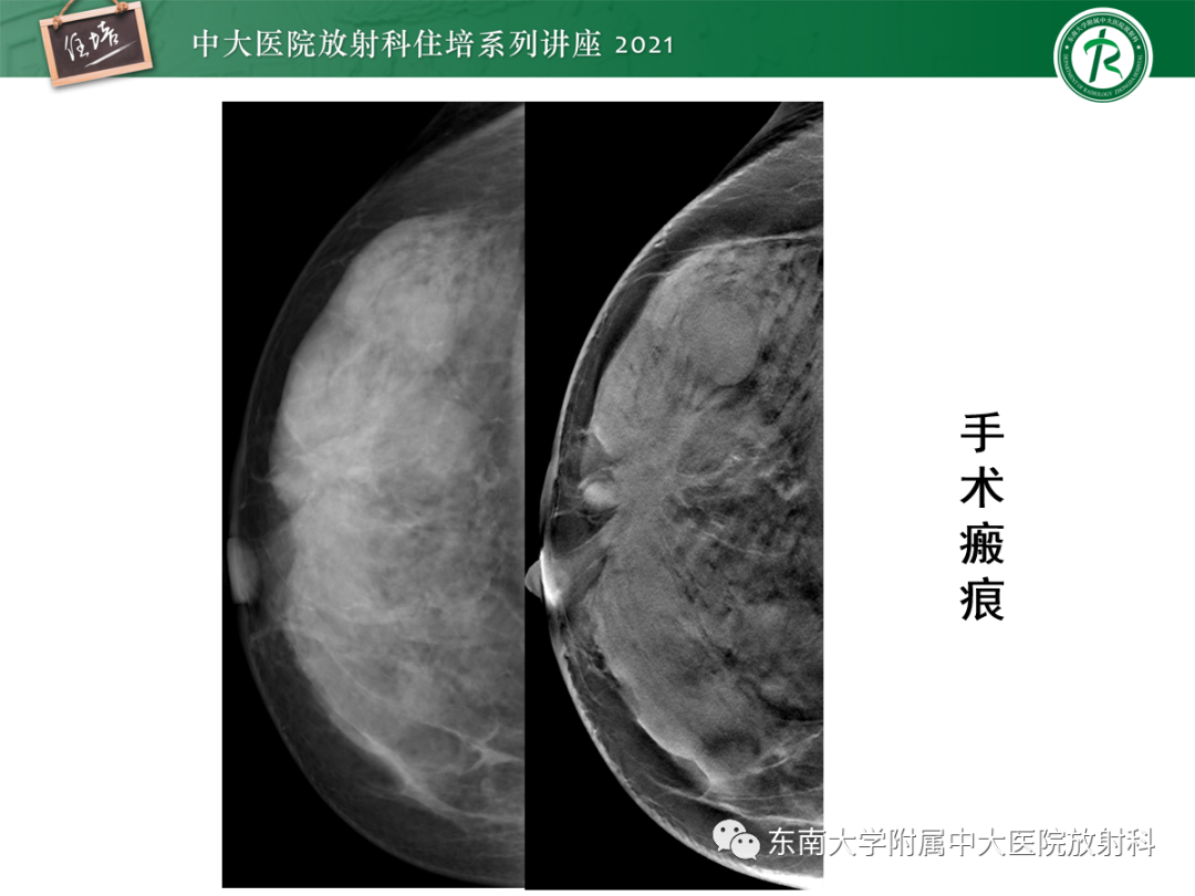 影像PPT - 【PPT】乳腺X线影像报告和数据系统（第五版）BI-RADS-45