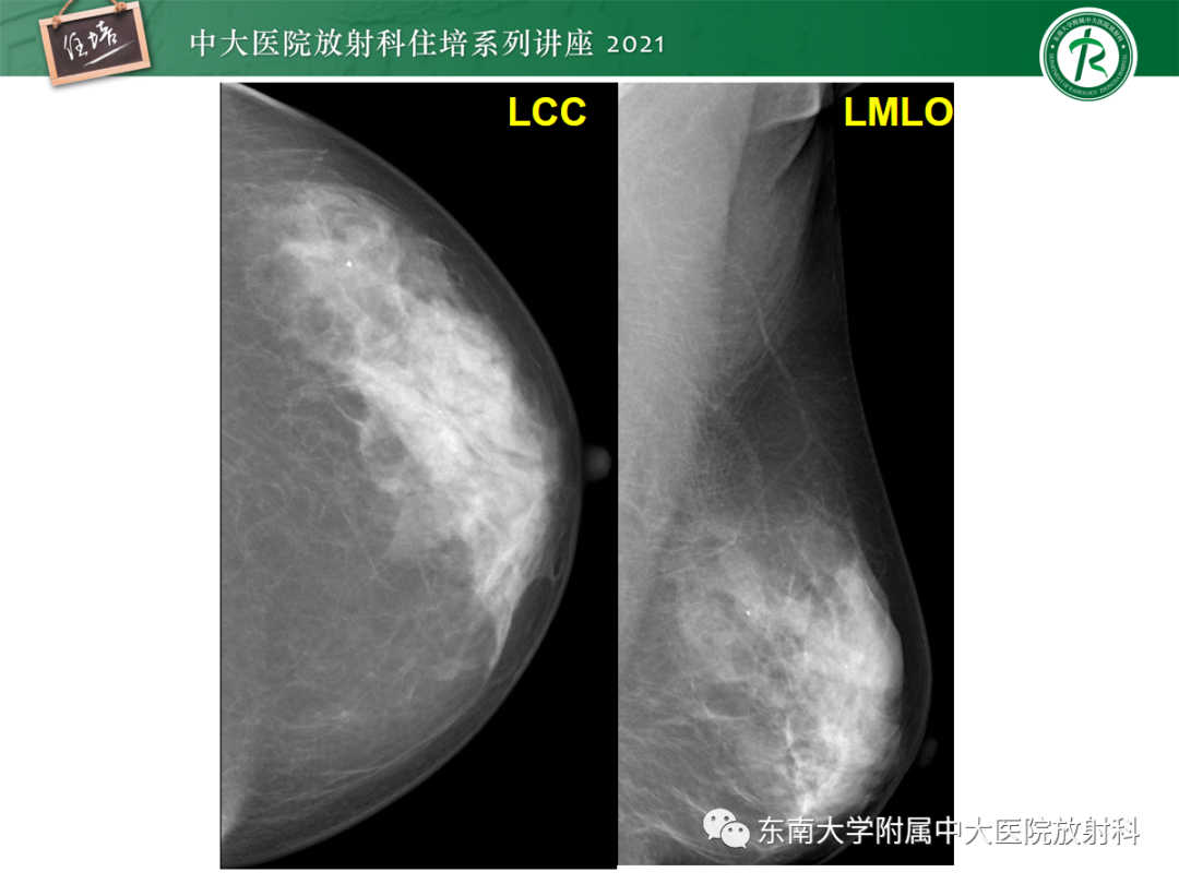 影像PPT - 【PPT】乳腺X线影像报告和数据系统（第五版）BI-RADS-46