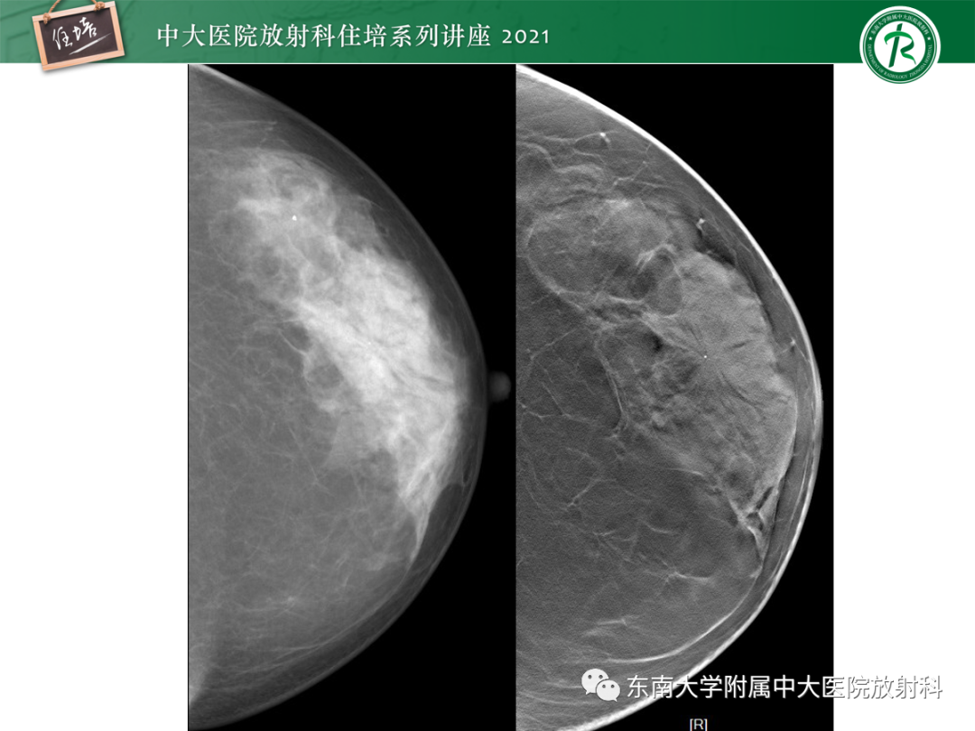 影像PPT - 【PPT】乳腺X线影像报告和数据系统（第五版）BI-RADS-47