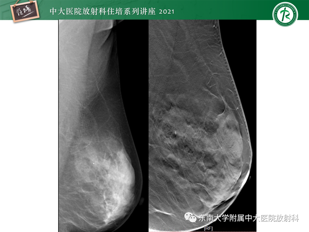 影像PPT - 【PPT】乳腺X线影像报告和数据系统（第五版）BI-RADS-48