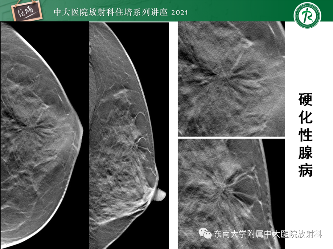 影像PPT - 【PPT】乳腺X线影像报告和数据系统（第五版）BI-RADS-51