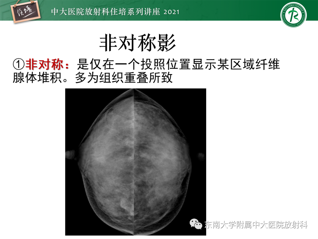 影像PPT - 【PPT】乳腺X线影像报告和数据系统（第五版）BI-RADS-53