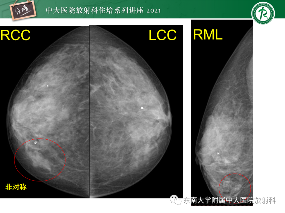 影像PPT - 【PPT】乳腺X线影像报告和数据系统（第五版）BI-RADS-54