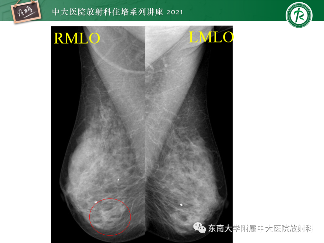 影像PPT - 【PPT】乳腺X线影像报告和数据系统（第五版）BI-RADS-55