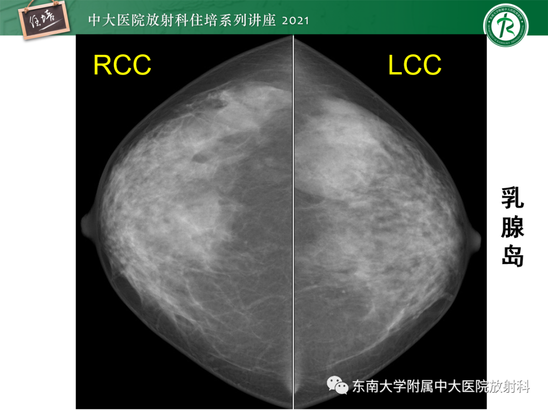 影像PPT - 【PPT】乳腺X线影像报告和数据系统（第五版）BI-RADS-57