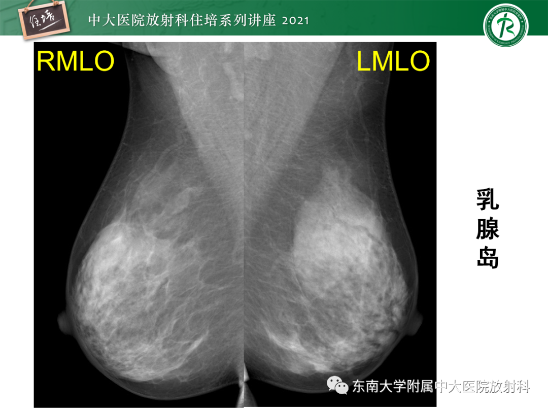 影像PPT - 【PPT】乳腺X线影像报告和数据系统（第五版）BI-RADS-58