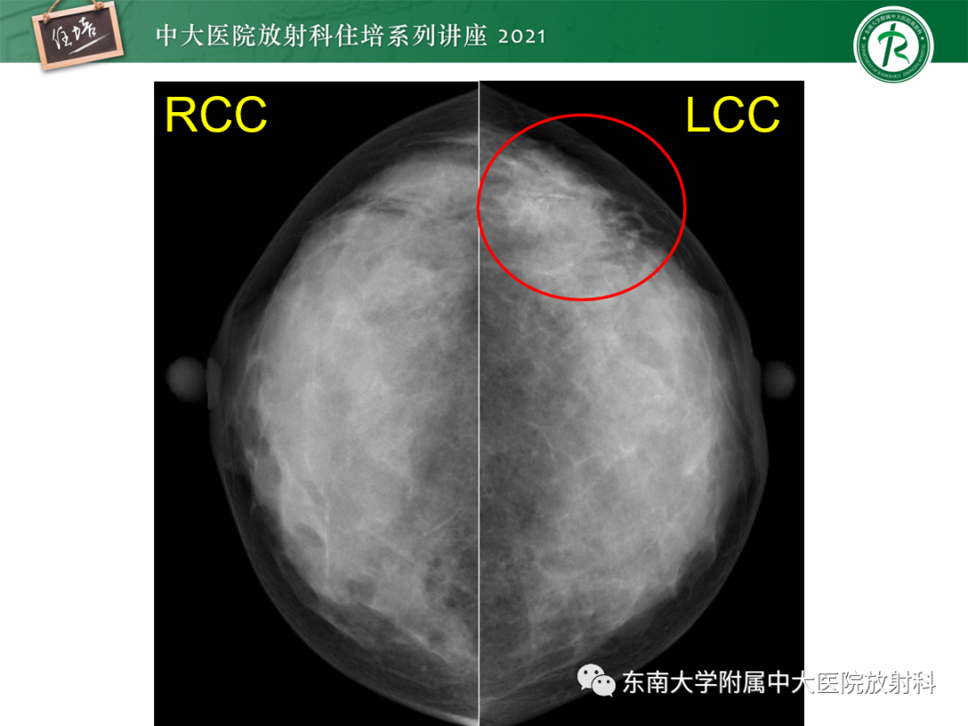 影像PPT - 【PPT】乳腺X线影像报告和数据系统（第五版）BI-RADS-59