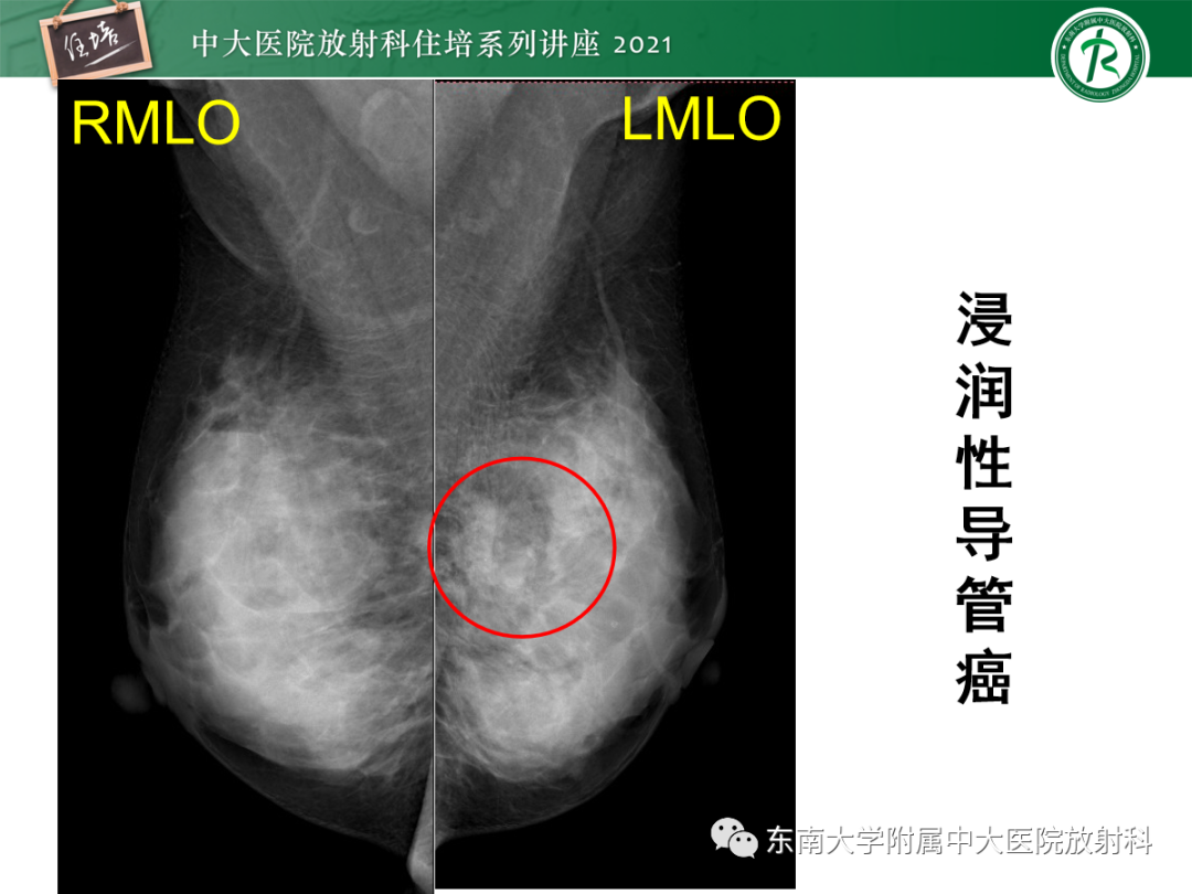 影像PPT - 【PPT】乳腺X线影像报告和数据系统（第五版）BI-RADS-60