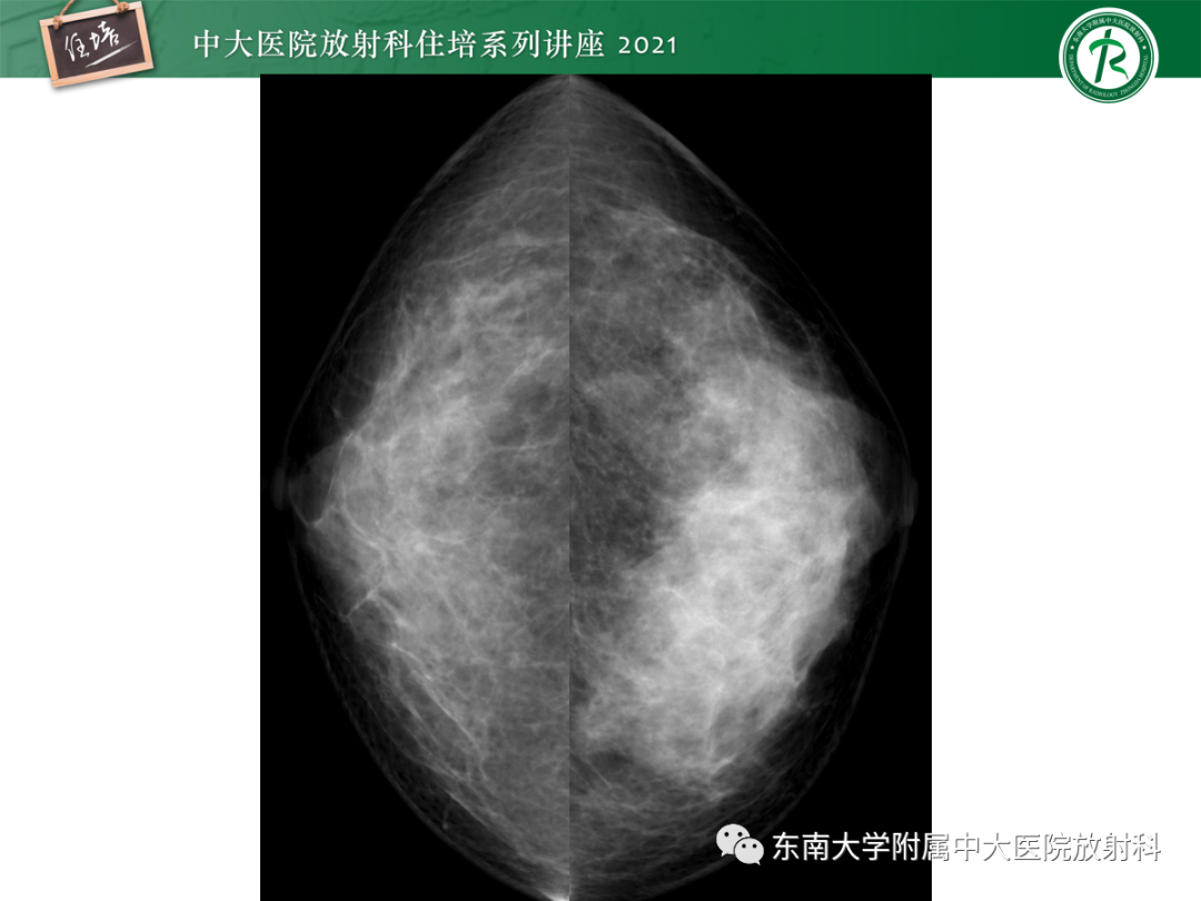 影像PPT - 【PPT】乳腺X线影像报告和数据系统（第五版）BI-RADS-62
