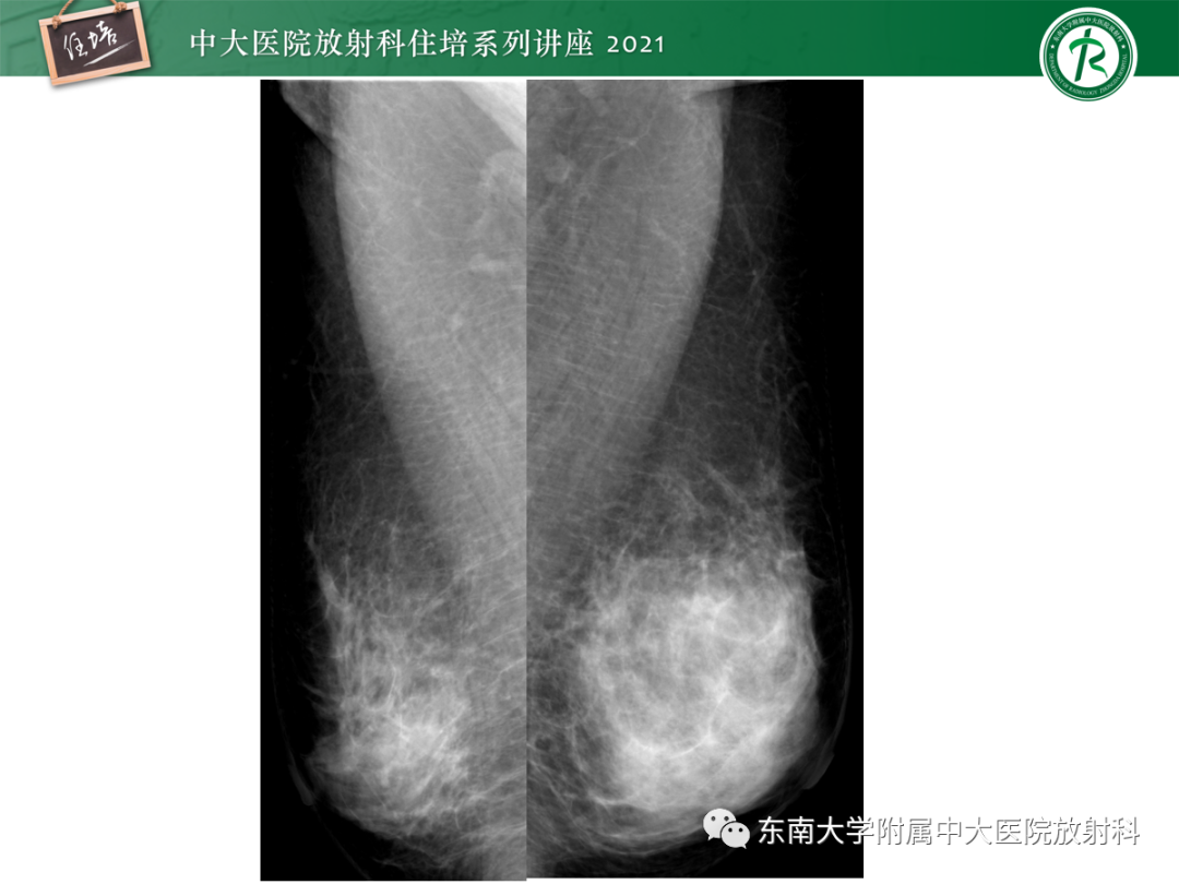 影像PPT - 【PPT】乳腺X线影像报告和数据系统（第五版）BI-RADS-63